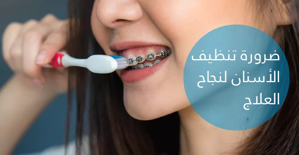 طرق تقويم الأسنان و كيفية المحافظة على النتائج
